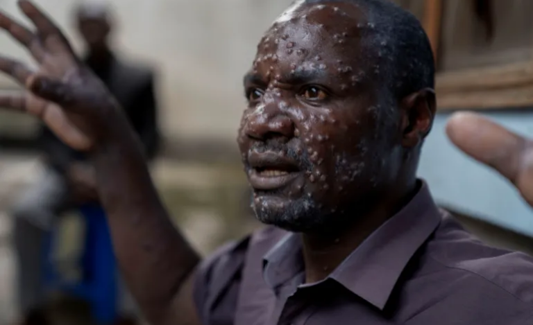 Caabuqa Mpox oo lagu arkay Deegaanada ismaamulka Soomaali Galbeed