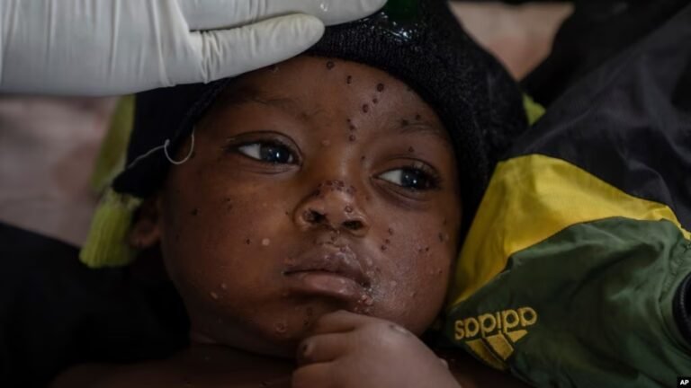Mpox cases in Congo may be stabilizing, but more vaccines needed to stamp out virus