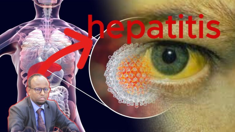 {DAAWO MUUQAALKA}  Heerka cudurka Cagaarshowga Soomaaliya oo Gaaray meel laga naxo